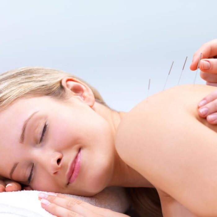Acupuncture Dry Needling