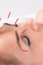 Acupuncture_Dry_Needling (2)